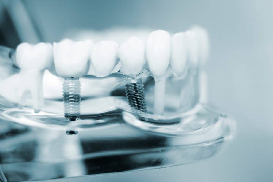 Are Dental Implants