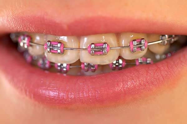 Close-up of Metal Braces