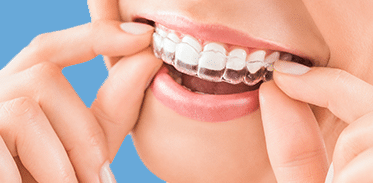 Clear Aligners Image