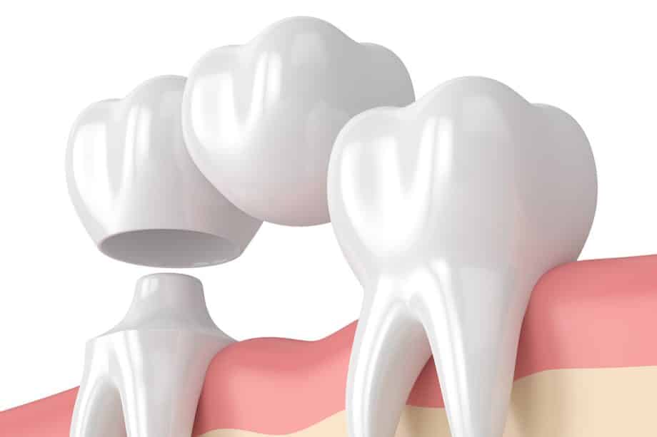 Can a Dental Bridge Be Removed & Recemented?