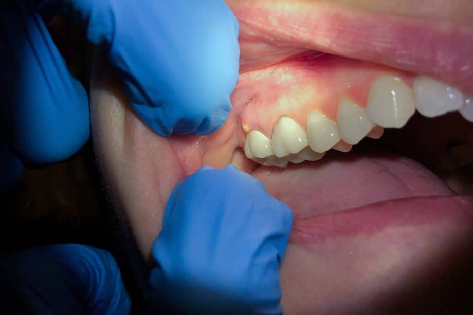 Dental Abscess Warning Signs You Should Never Ignore