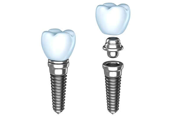 Dental Implant Illustration