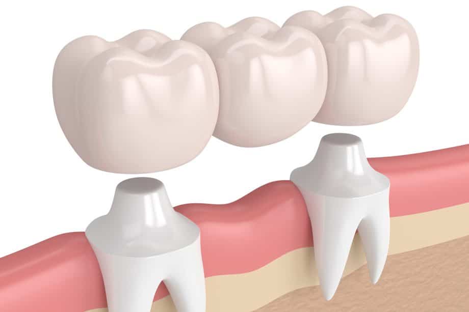 How Long Does A Dental Bridge Last?