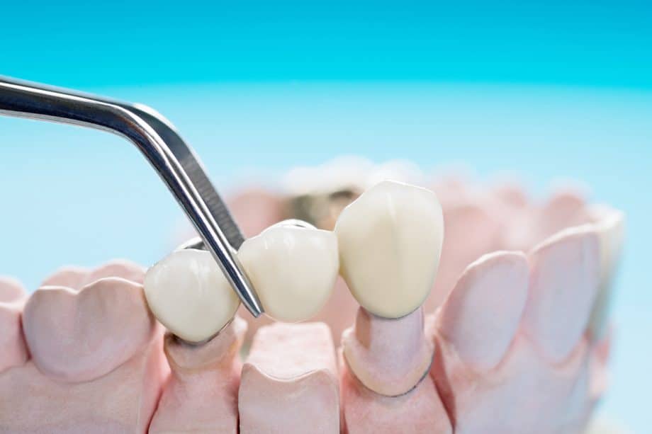 How Long Does It Take For A Dental Bridge To Settle?