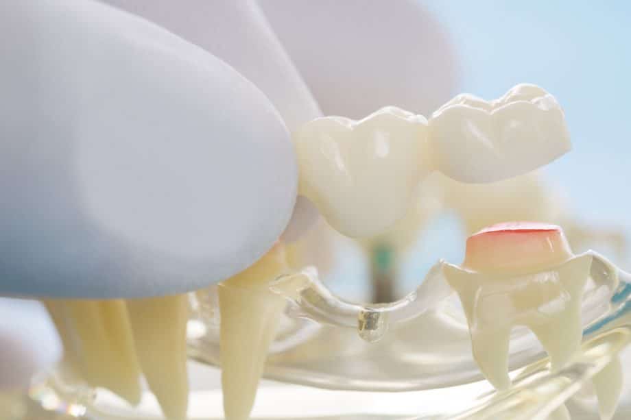 How Long Does It Take To Get Used To A Dental Bridge?