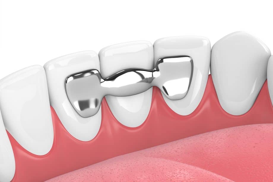 How Should a Dental Bridge Fit? | Richland Hills