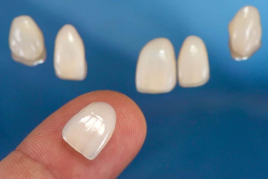 How to Choose Between Veneers and Bonding for Your Smile Goals