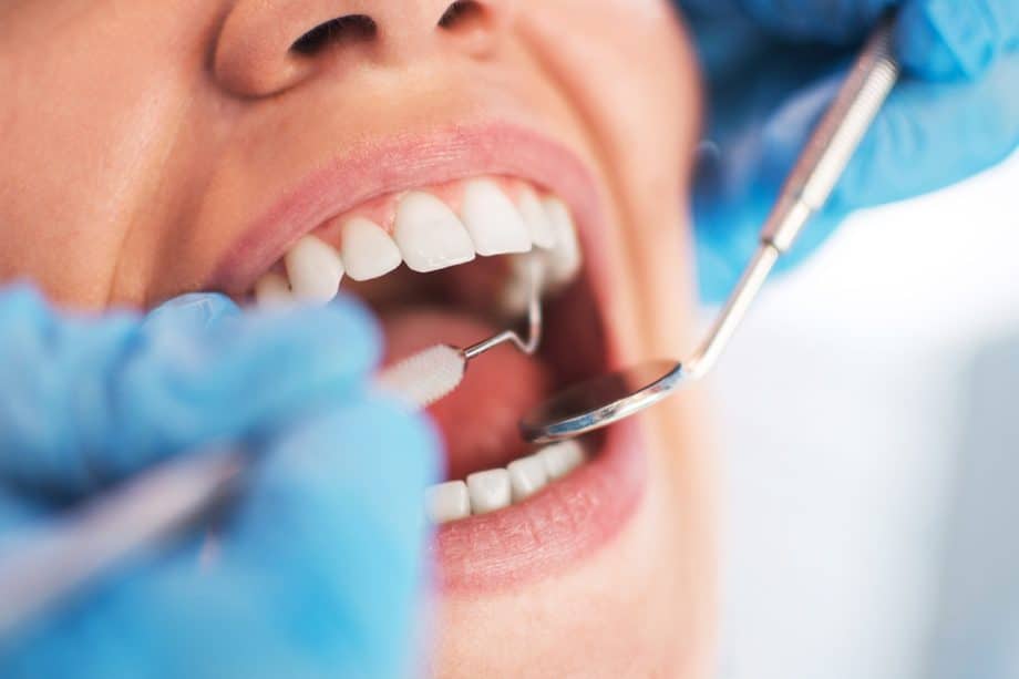 Teeth Whitening Options That Actually Work