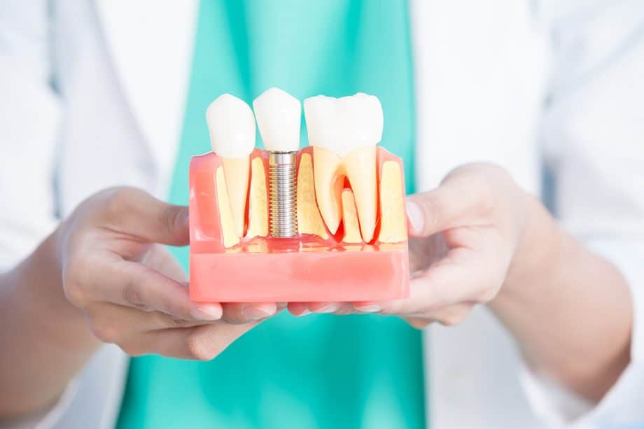 What are Dental Implants?