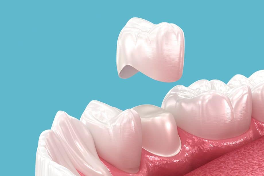 What Are the Signs You May Need a New Dental Crown or Bridge?