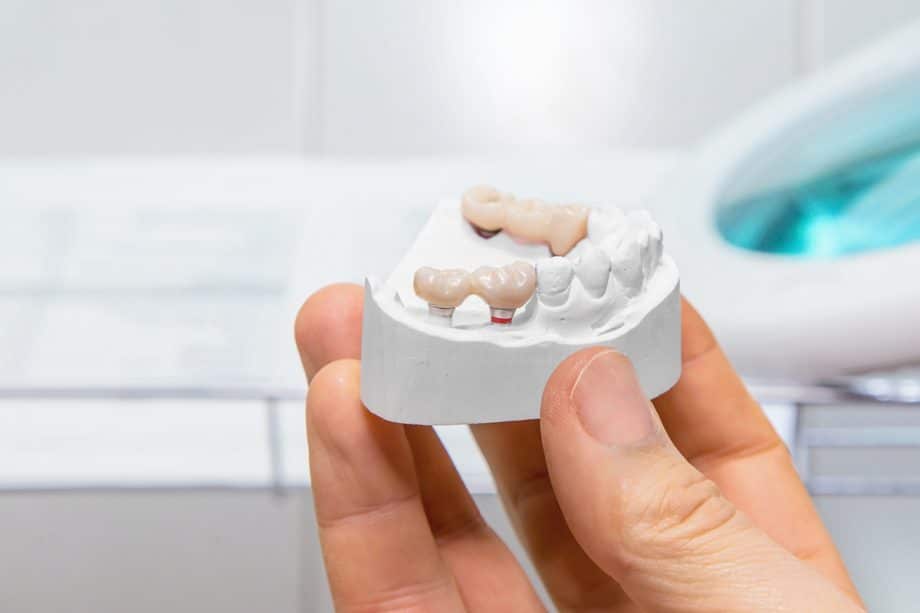 What is a dental bridge?