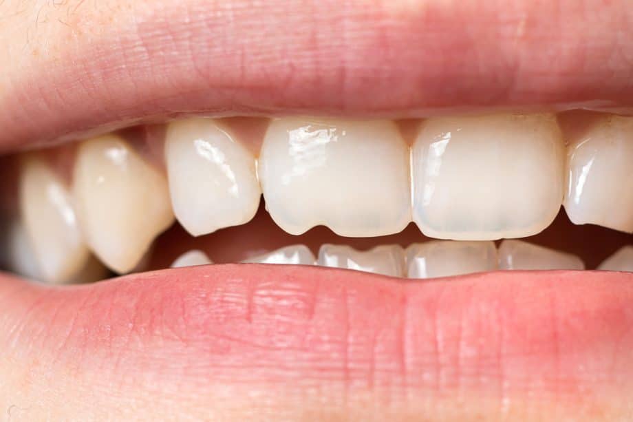 What to Do If You Chip or Break a Tooth Over the Weekend